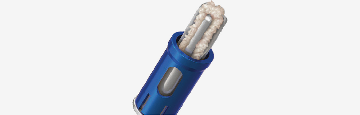 CAS drill with autologous bone fragments collected between the cutting blades