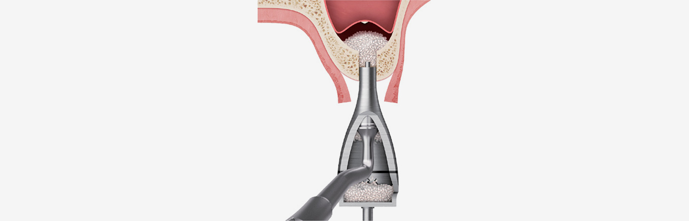 CAS funnel-shaped bone graft carrier delivering graft material to the sinus-elevation site