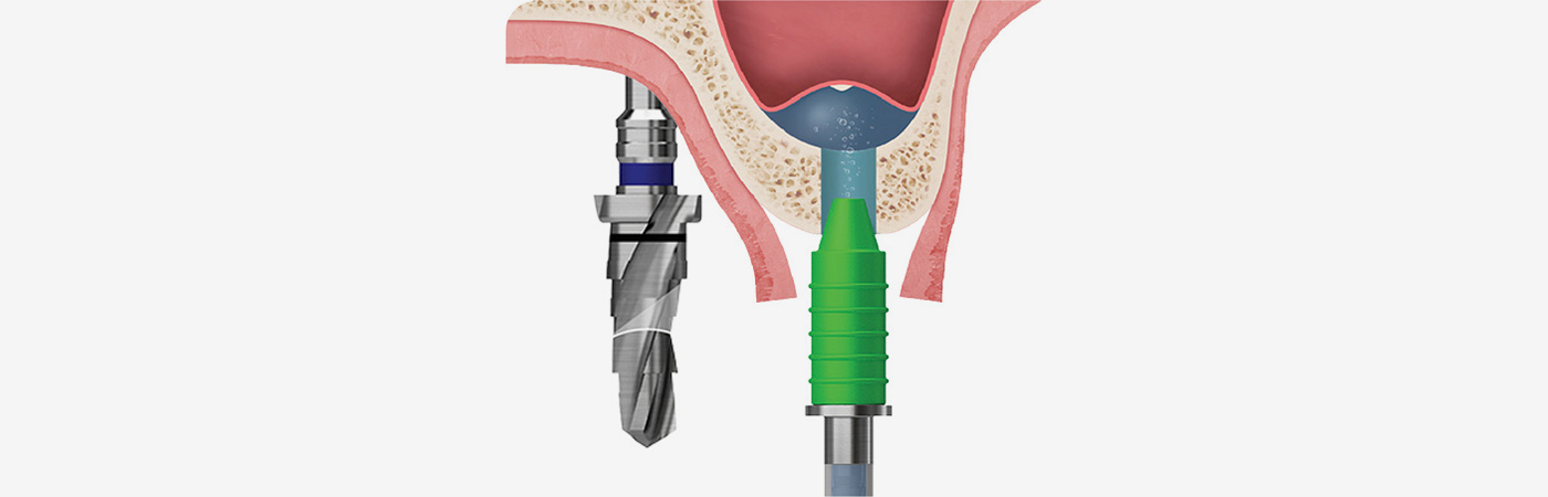 Illustration of hydraulic maxillary sinus membrane elevation with the CAS membrane elevator