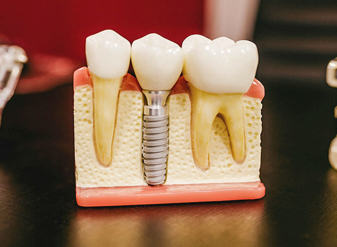 Dental implant demonstration model representing implant placement
