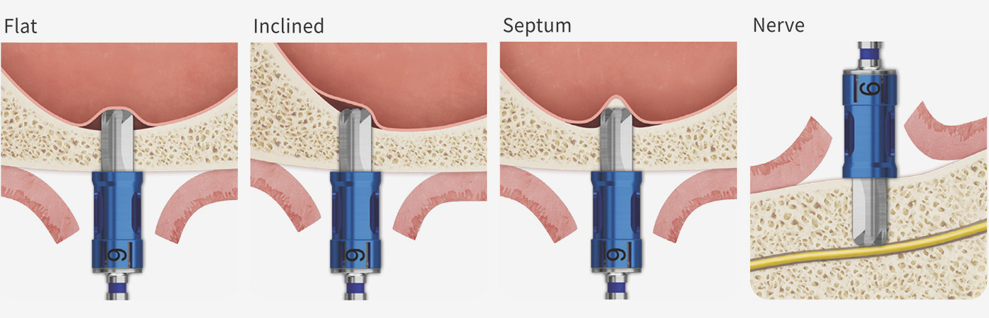 CAS drill illustrations for flat, inclined and septum-adjacent maxillary sinus-floor anatomy