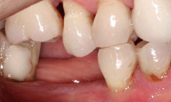 Preoperative clinical view for lower-right molar implant case