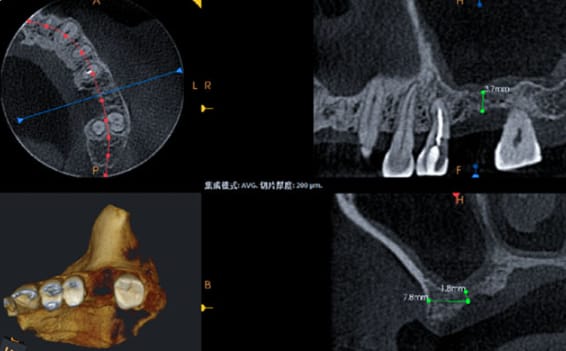 CBCT image for maxillary sinus elevation implant case