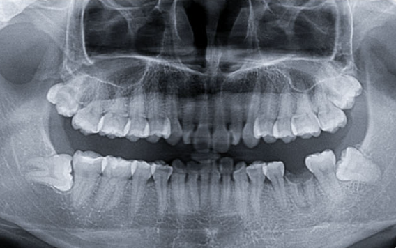 Initial radiograph for delayed mandibular molar implant case