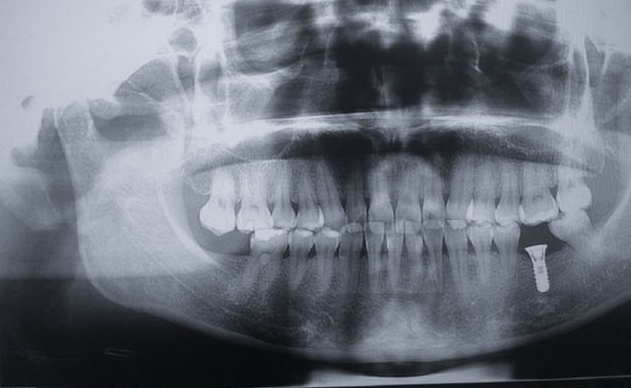 Clinical imaging for single mandibular molar implant case