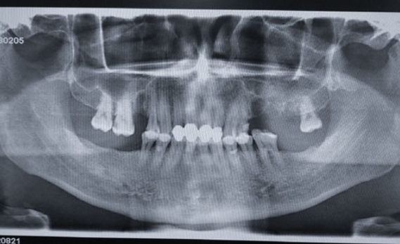 Preoperative imaging for multiple posterior implant case