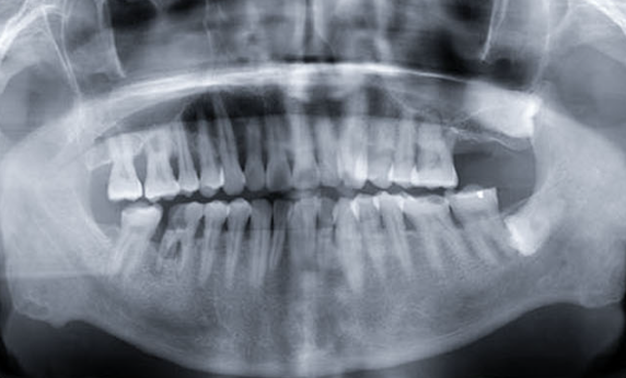 Extraction-site preservation image for mandibular molar case