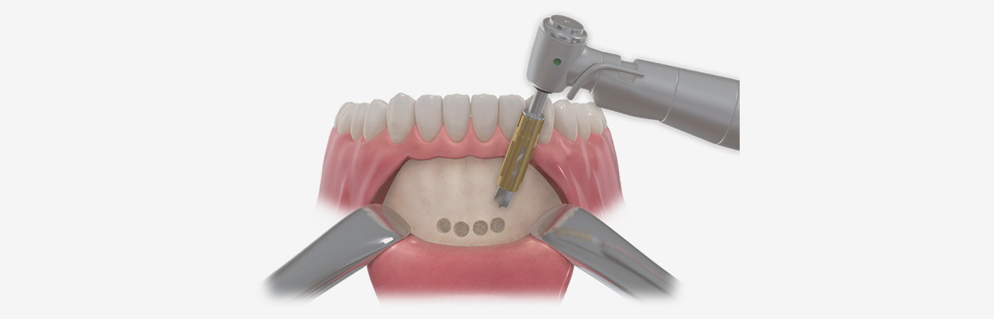 自体骨采集 instrument collecting bone from the anterior mandible