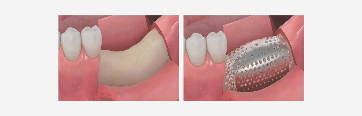 Before and after illustration of a titanium membrane supporting a larger-volume ridge graft
