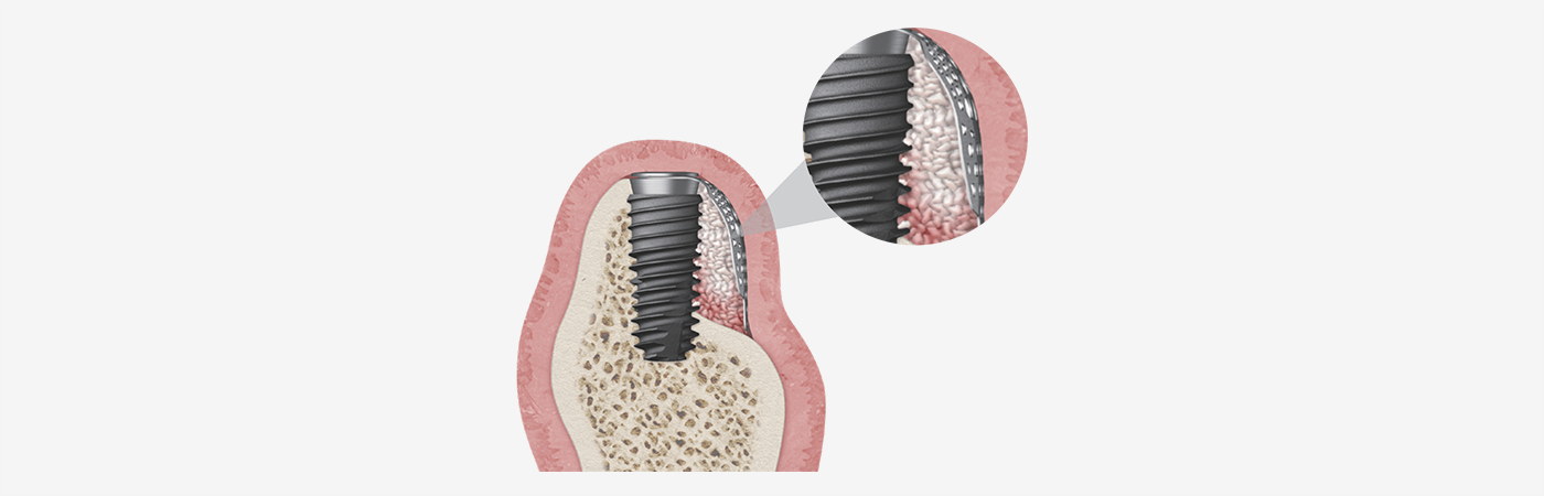 Titanium barrier membrane positioned beside a dental implant and bone graft