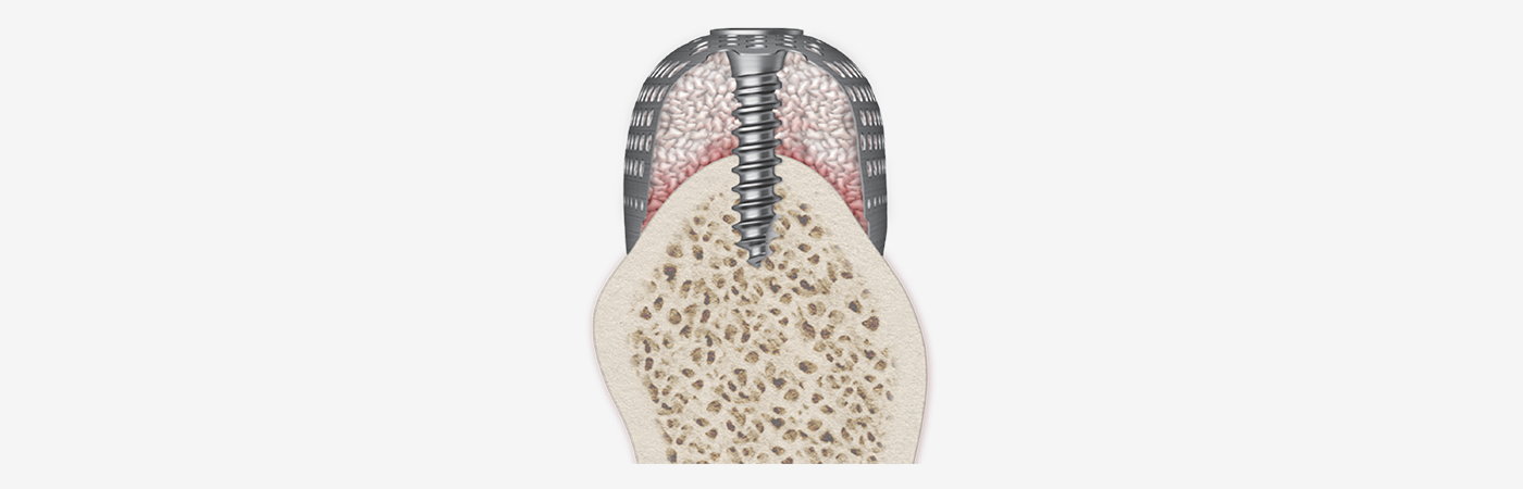 Tent screw supporting a titanium membrane and graft for vertical bone augmentation