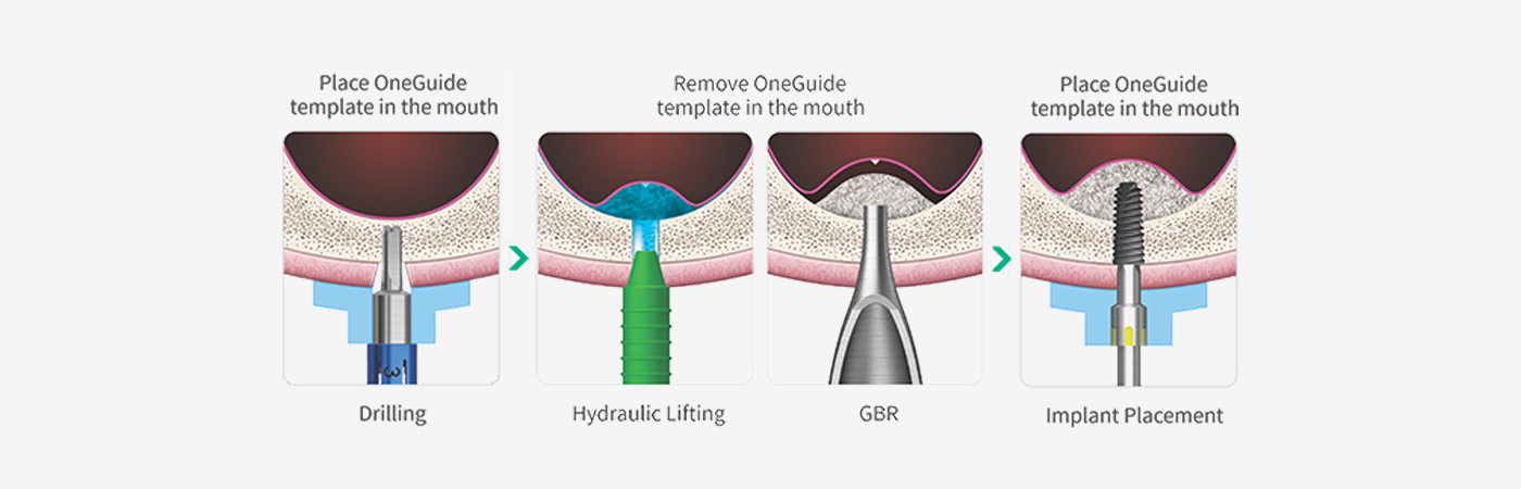 OneGuide sequence for drilling, hydraulic sinus lifting, guided bone regeneration and implant placement