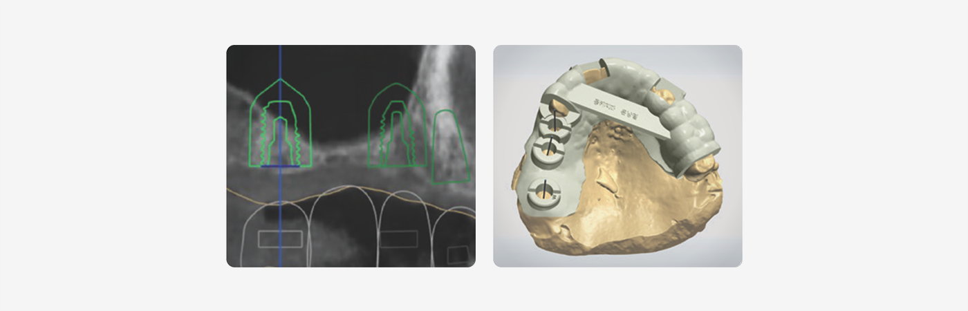 CBCT implant planning and a patient-specific dental surgical guide on a digital model