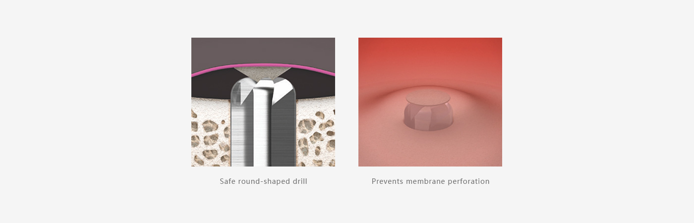 Illustration of a rounded CAS drill approaching the sinus membrane