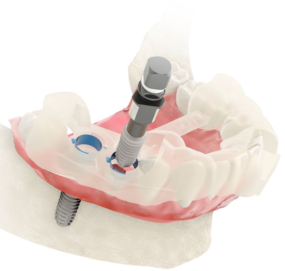 Digital implant planning and guided placement workflow