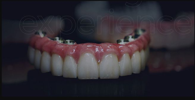 Digitally planned full-arch guide and provisional restoration