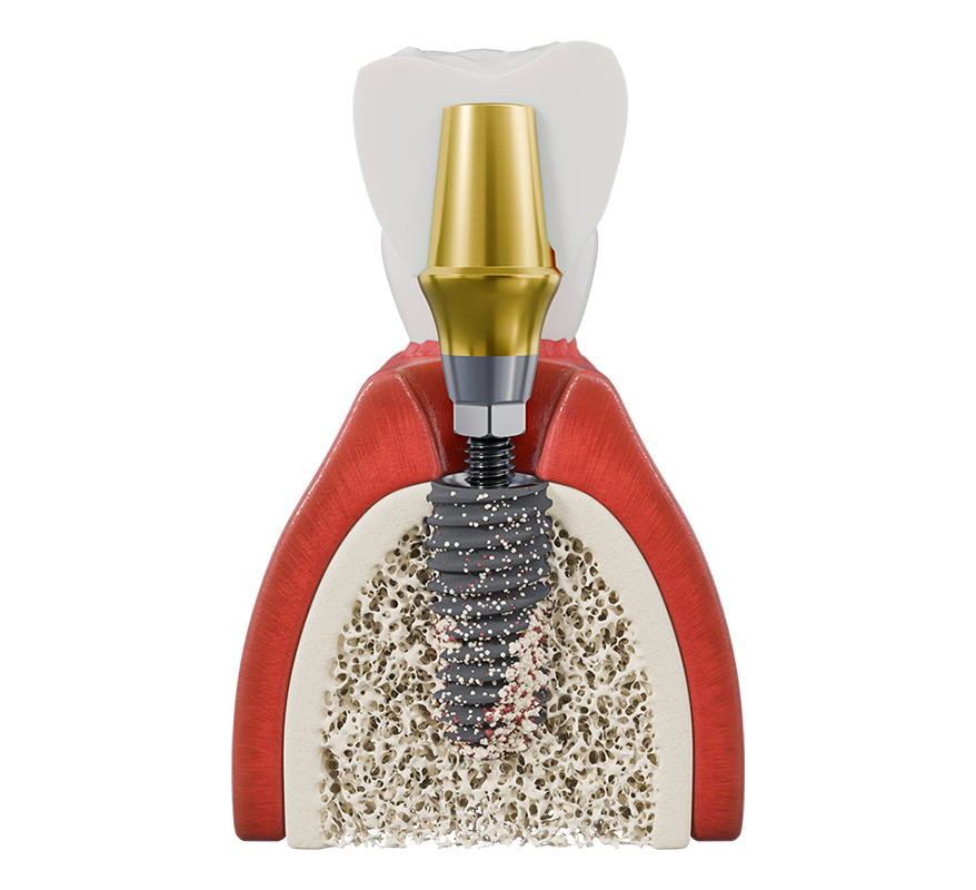 Select 优选系列 implant placed in an illustrated bone cross-section