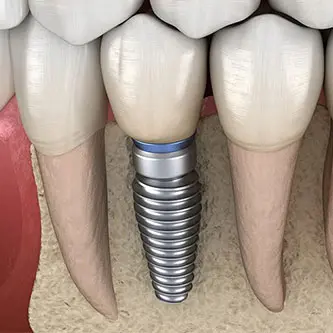 Dental implant positioned beside natural teeth for structural comparison