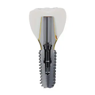 Sectioned view of a dental implant fixation and abutment connection
