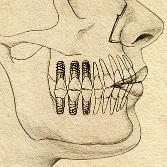 Illustration of implant-supported teeth in the lower jaw