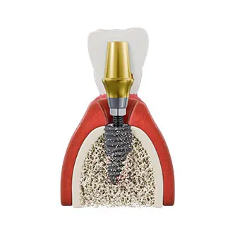 Cutaway illustration of an osseointegrated dental implant and crown